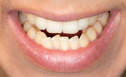 Woman with crowded teeth