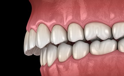 Illustration of an overbite