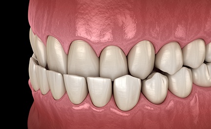 Digital illustration of underbite