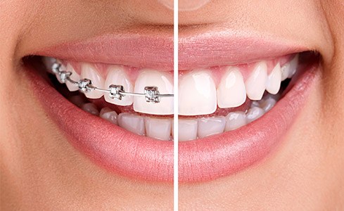 Clear Braces vs. Metal Braces, Frazer Dental Care, Dentist