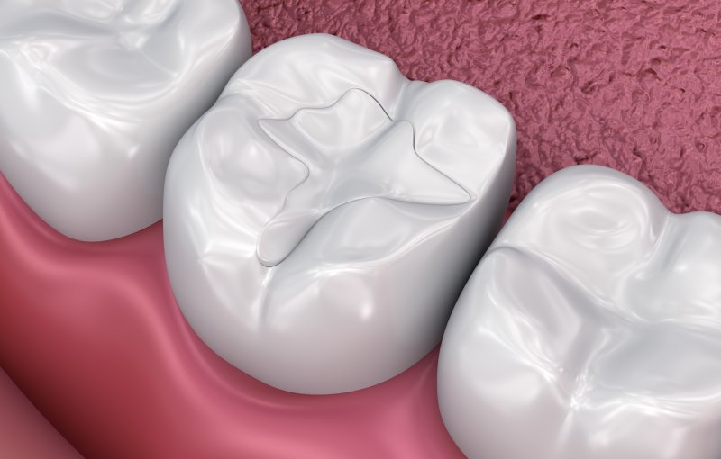 How Long Do Dental Fillings Last? - Kawveh Nofallah DMD